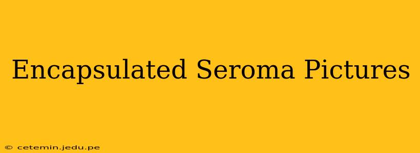 Encapsulated Seroma Pictures