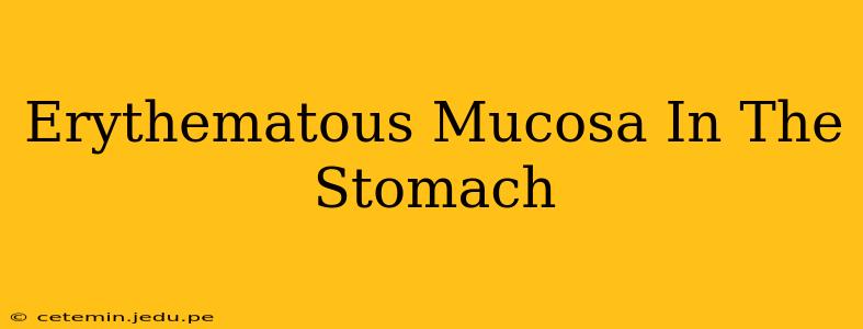 Erythematous Mucosa In The Stomach