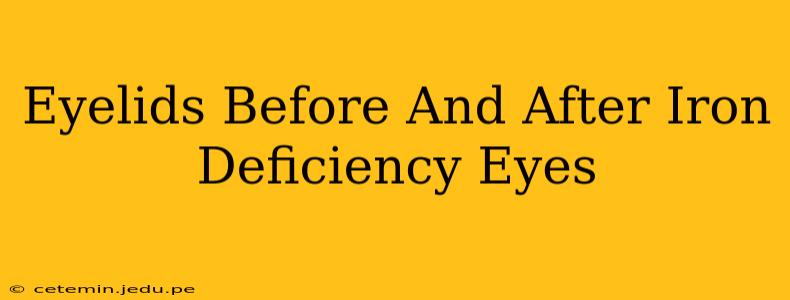Eyelids Before And After Iron Deficiency Eyes