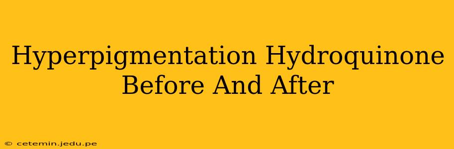 Hyperpigmentation Hydroquinone Before And After