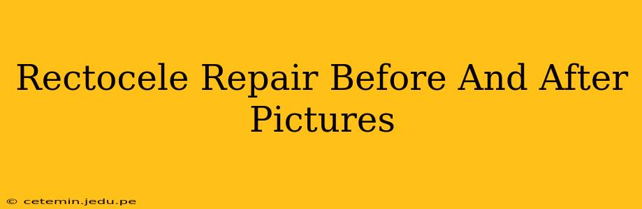 Rectocele Repair Before And After Pictures